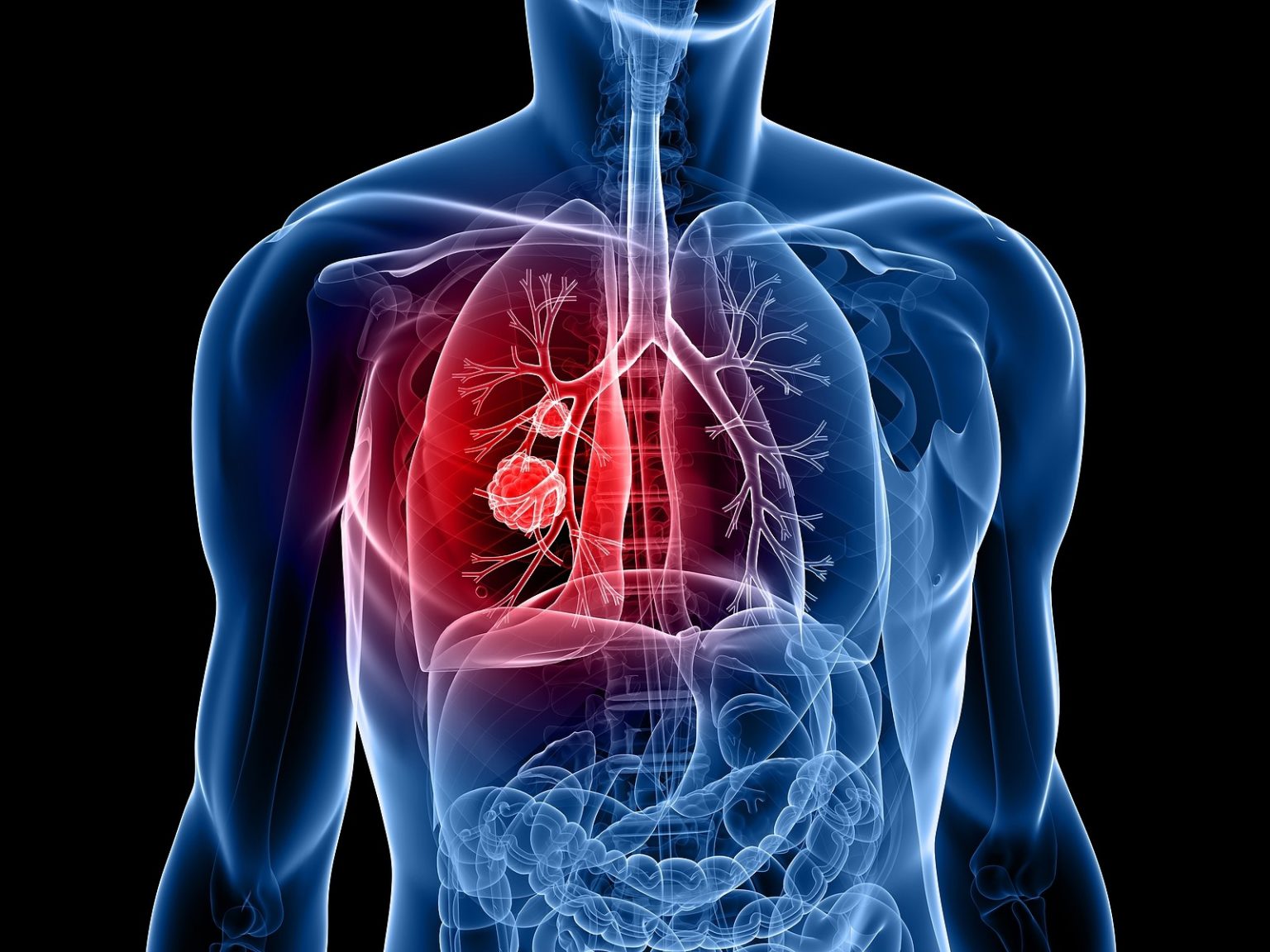 How To Know If You Have Lung Cancer Signs And Symptoms Beaumont Emergency Hospital