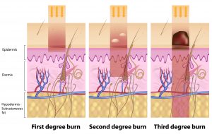 Different Degrees of Burns