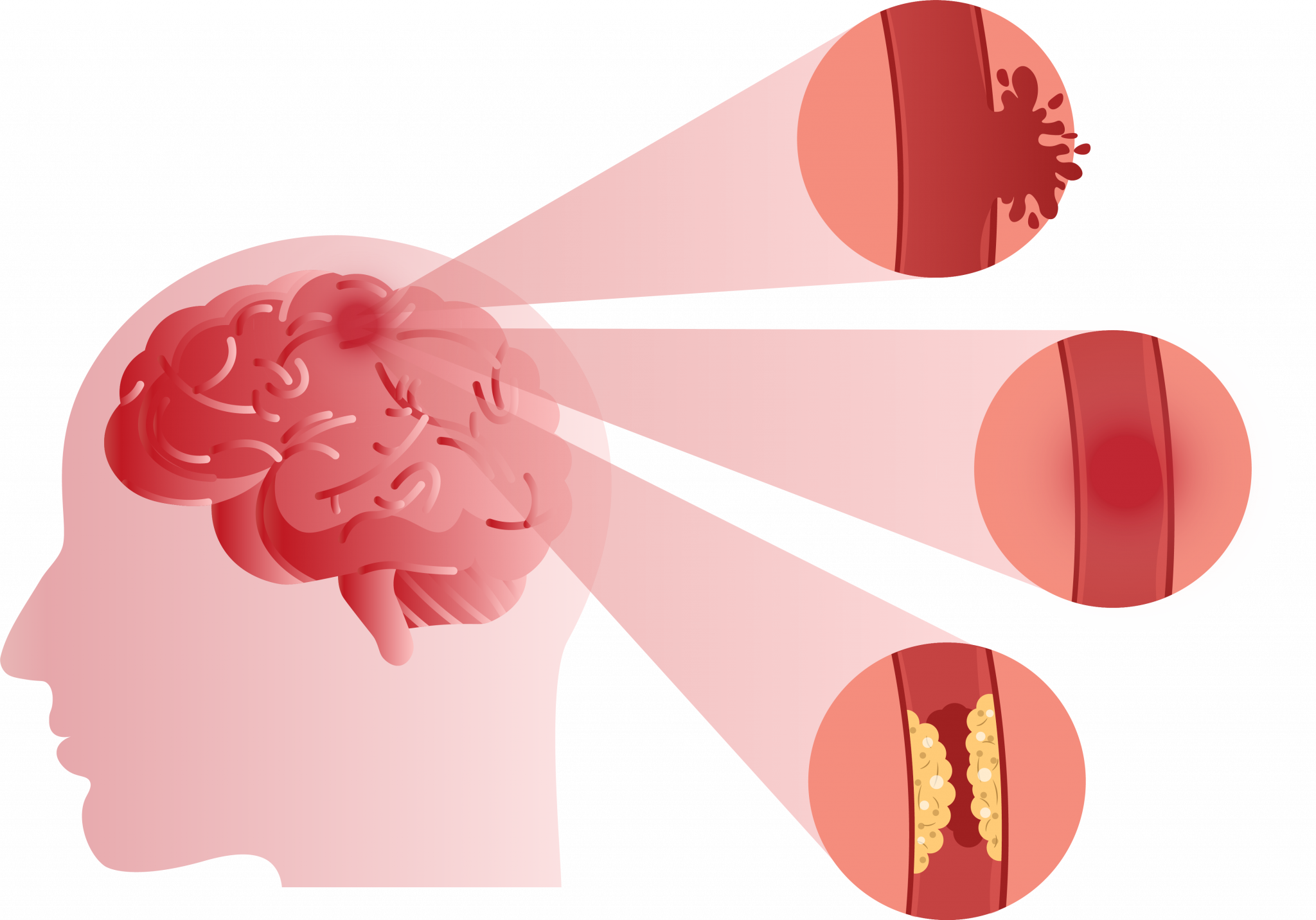 tia-transient-ischemic-attack-archives-beaumont-emergency-hospital