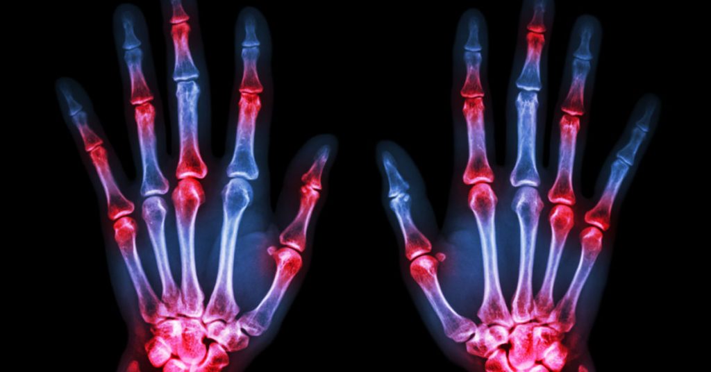 Arthritis Signs & Symptoms