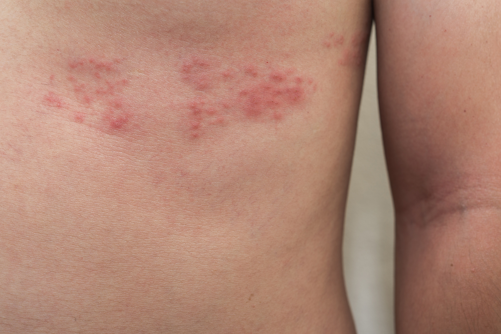 What is Shingles?