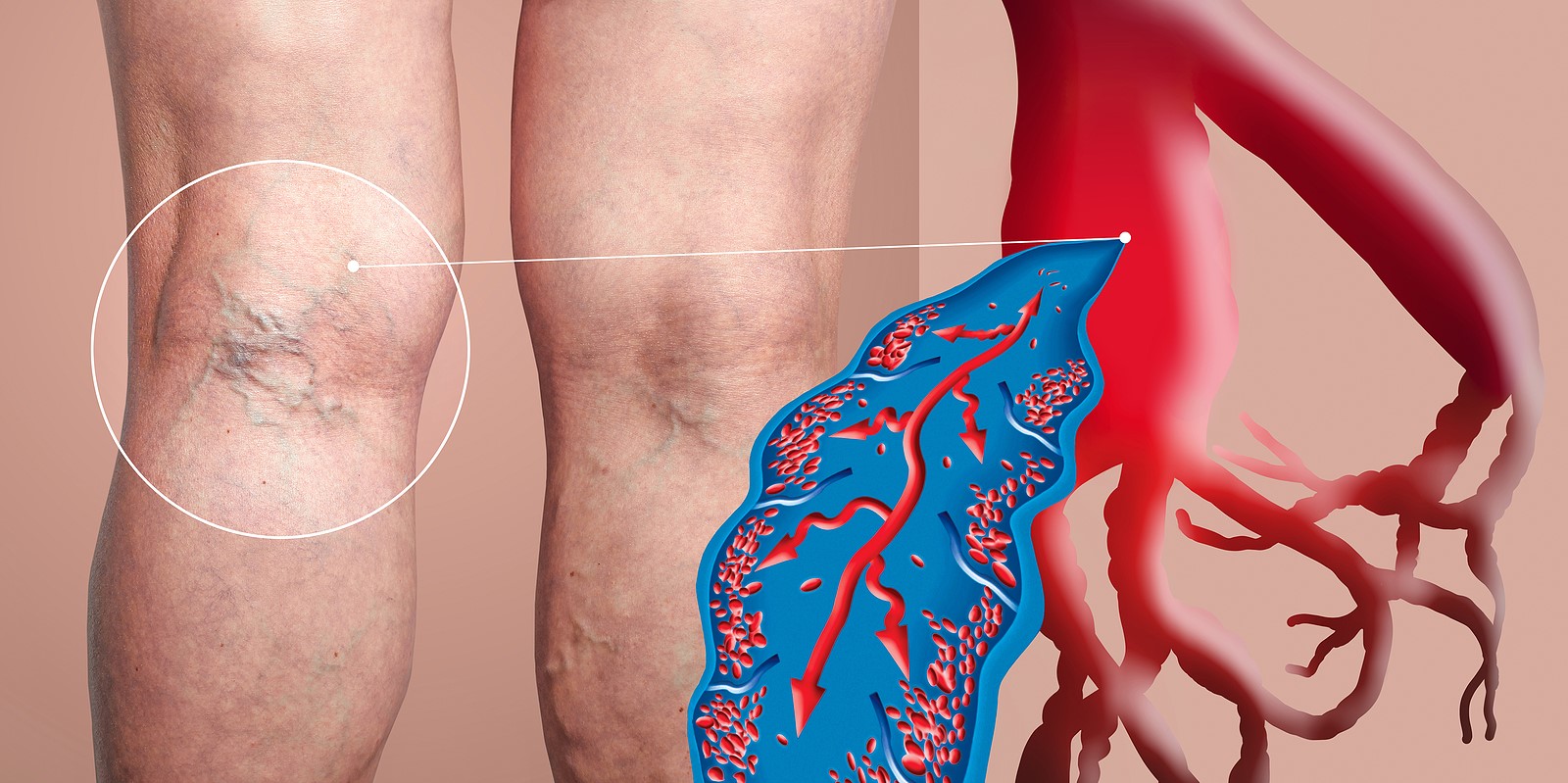 How to Know if You Have Deep Vein Thrombosis (DVT) - Beaumont