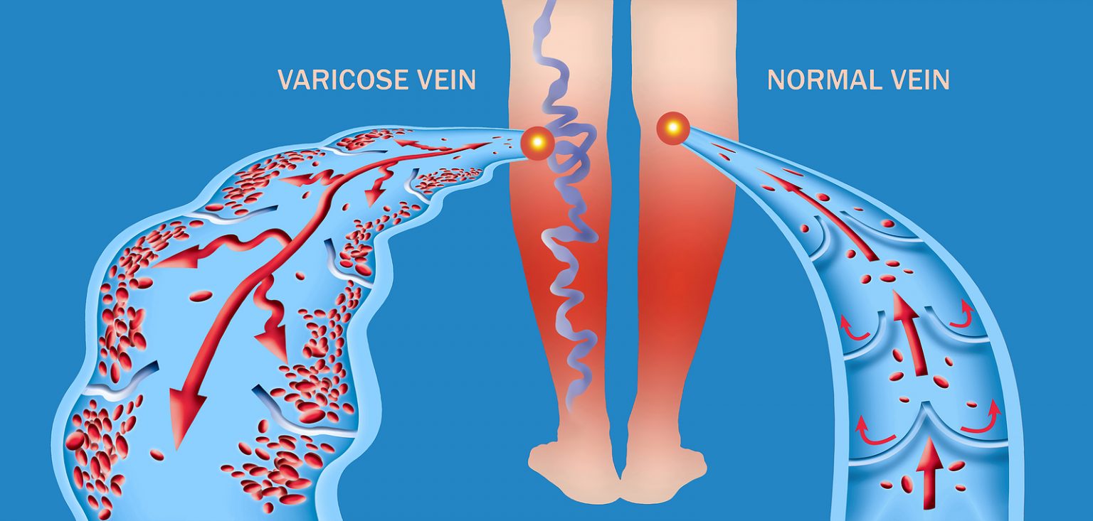 Varicose Veins Vs Spider Veins What You Need To Know Beaumont Emergency Hospital 7932