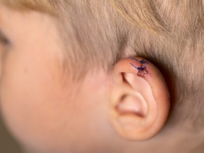 How to Know if My Child Needs Stitches