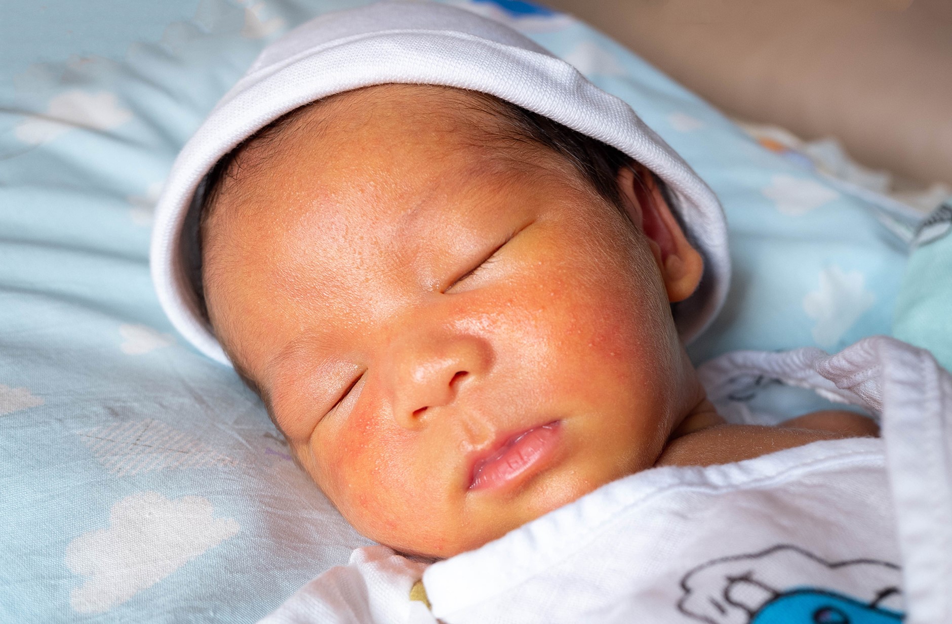 Infant Jaundice - Beaumont Emergency Hospital