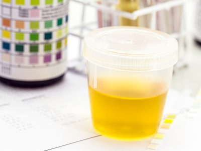 What Blood In Your Urine Can Mean