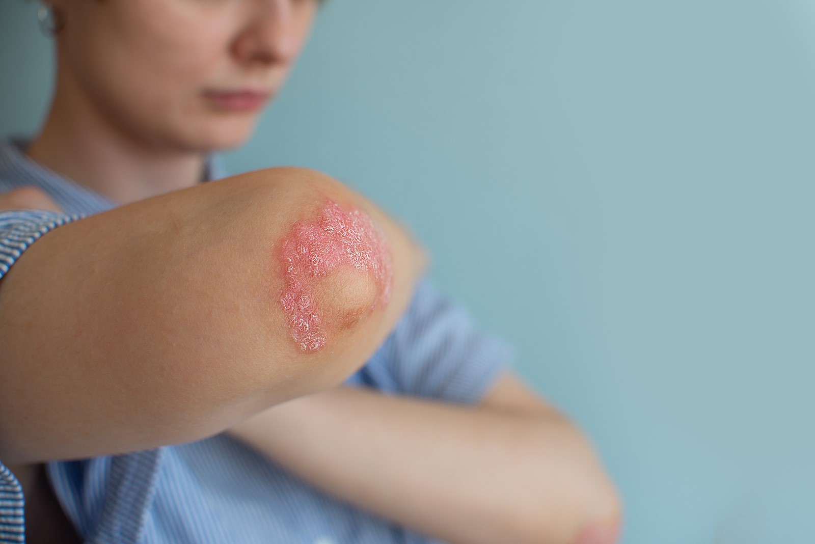 Do I Have Psoriasis
