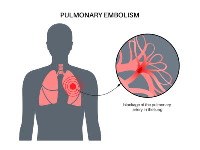 3 Symptoms of Pulmonary Embolism
