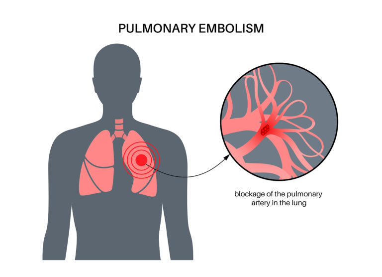 3 Symptoms Of Pulmonary Embolism - Beaumont Emergency Hospital