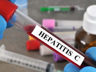 Diagnosis and Treatment of Hepatitis C